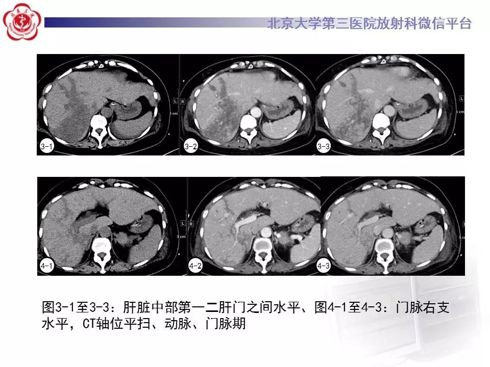 【病例】HELLP综合征肝脏影像学表现1例