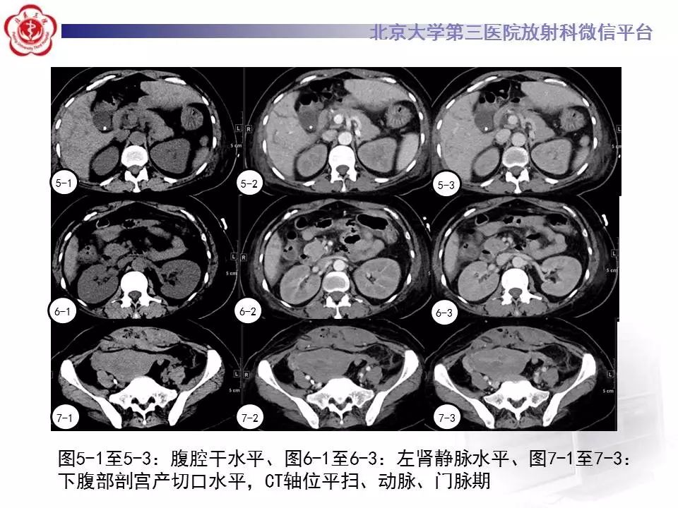 【病例】HELLP综合征肝脏影像学表现1例