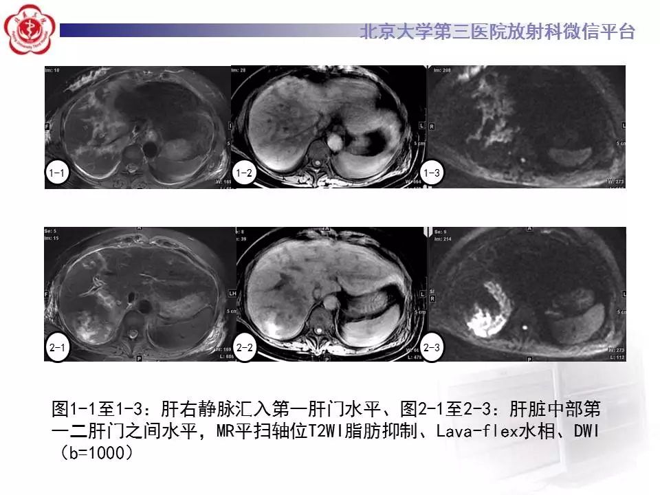 【病例】HELLP综合征肝脏影像学表现1例