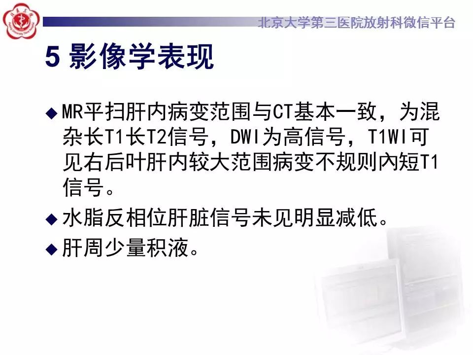 【病例】HELLP综合征肝脏影像学表现1例