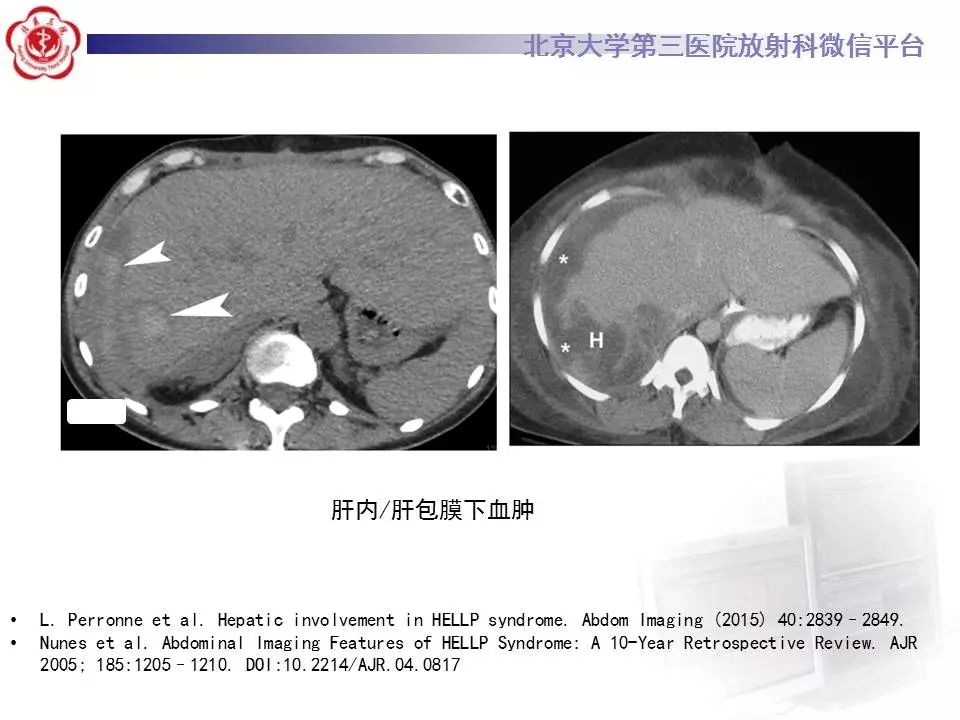 【病例】HELLP综合征肝脏影像学表现1例