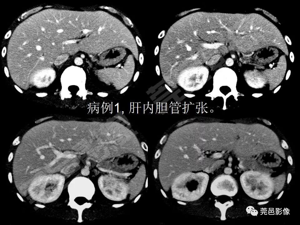 【PPT】氯胺酮相关性肝胆、泌尿系统损害的CT诊断