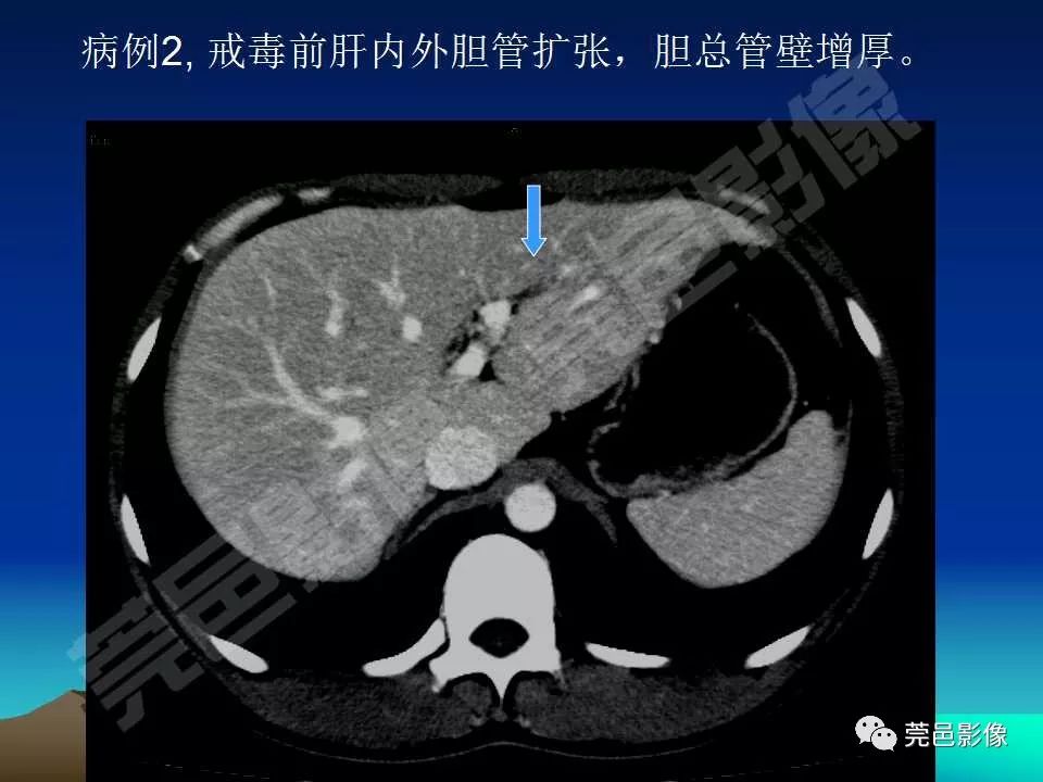【PPT】氯胺酮相关性肝胆、泌尿系统损害的CT诊断