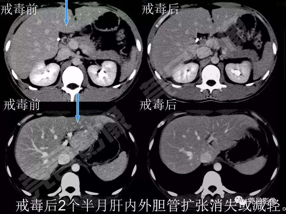 【PPT】氯胺酮相关性肝胆、泌尿系统损害的CT诊断