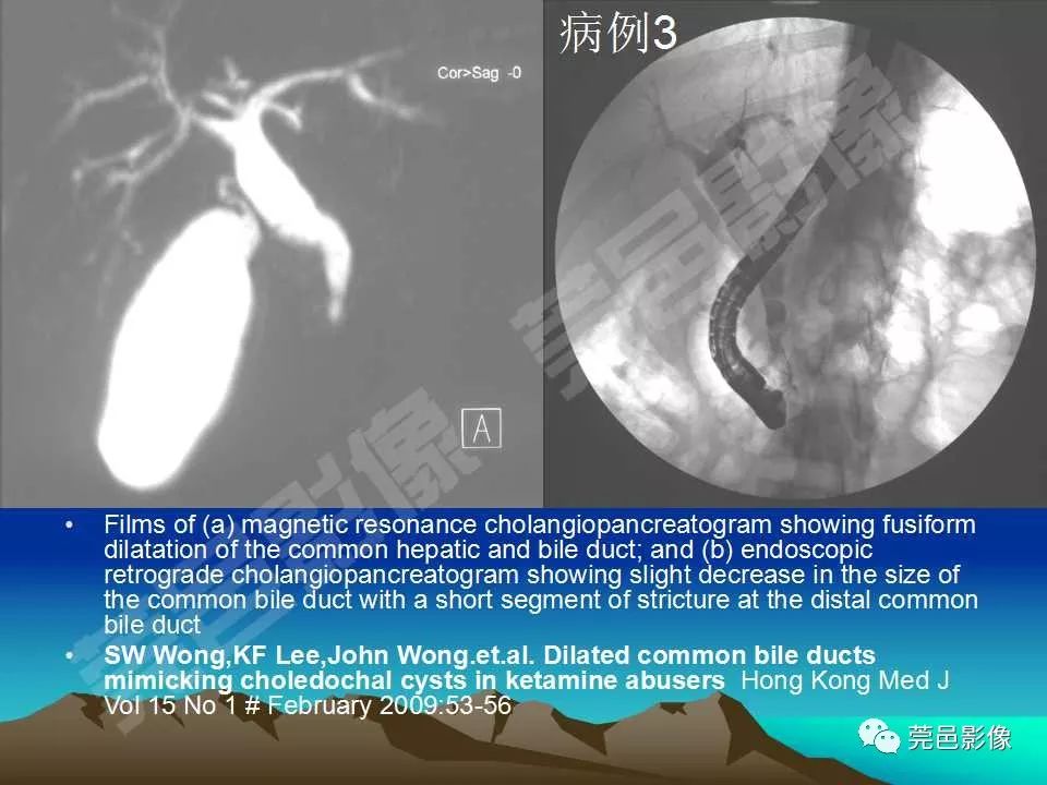 【PPT】氯胺酮相关性肝胆、泌尿系统损害的CT诊断