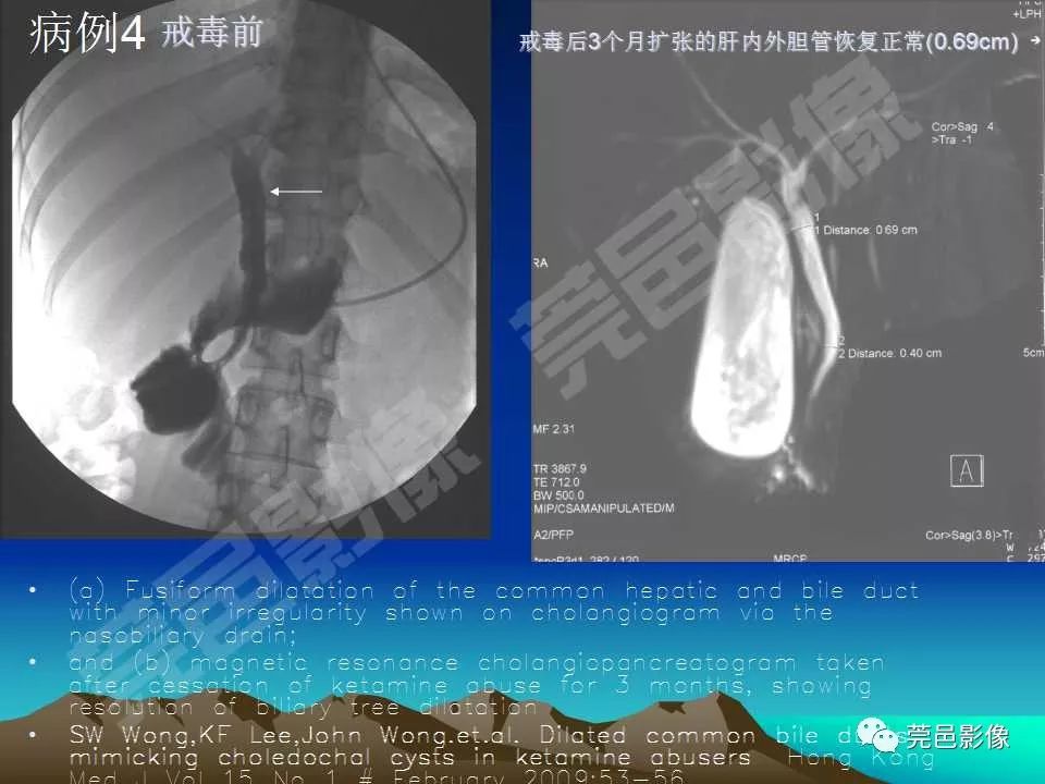 【PPT】氯胺酮相关性肝胆、泌尿系统损害的CT诊断