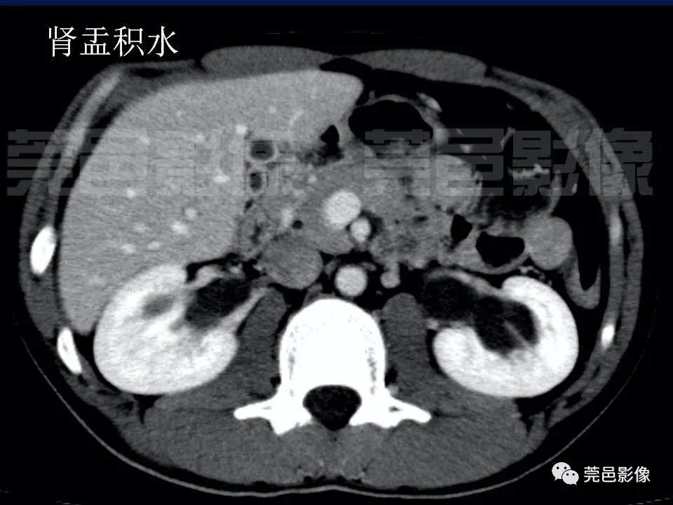【PPT】氯胺酮相关性肝胆、泌尿系统损害的CT诊断