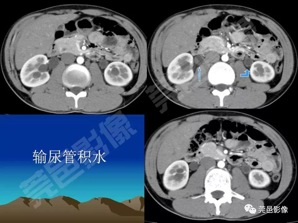 【PPT】氯胺酮相关性肝胆、泌尿系统损害的CT诊断