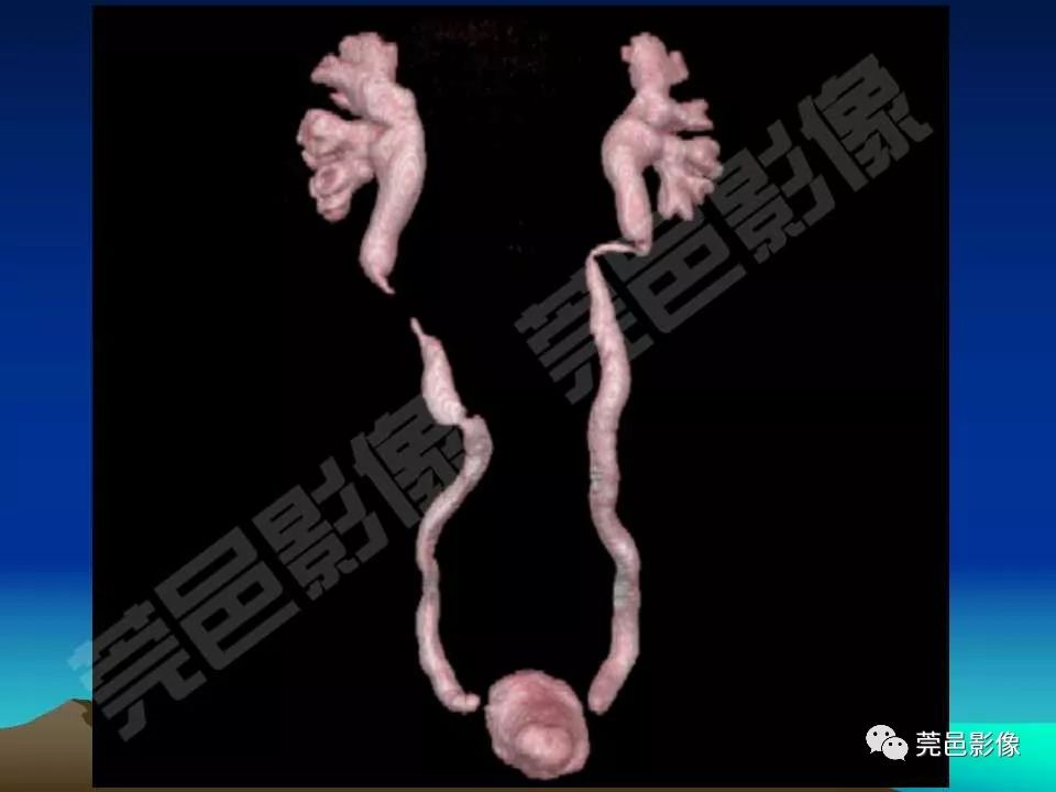 【PPT】氯胺酮相关性肝胆、泌尿系统损害的CT诊断