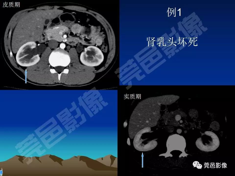 【PPT】氯胺酮相关性肝胆、泌尿系统损害的CT诊断