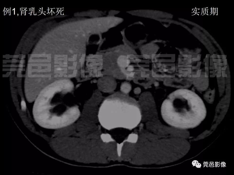 【PPT】氯胺酮相关性肝胆、泌尿系统损害的CT诊断