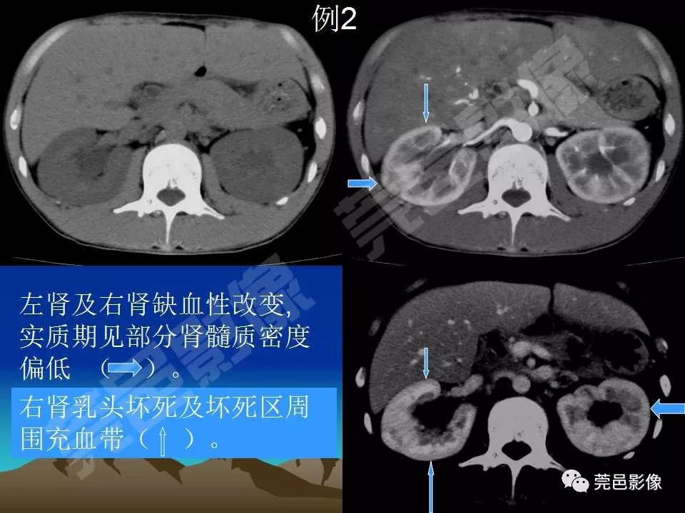 【PPT】氯胺酮相关性肝胆、泌尿系统损害的CT诊断