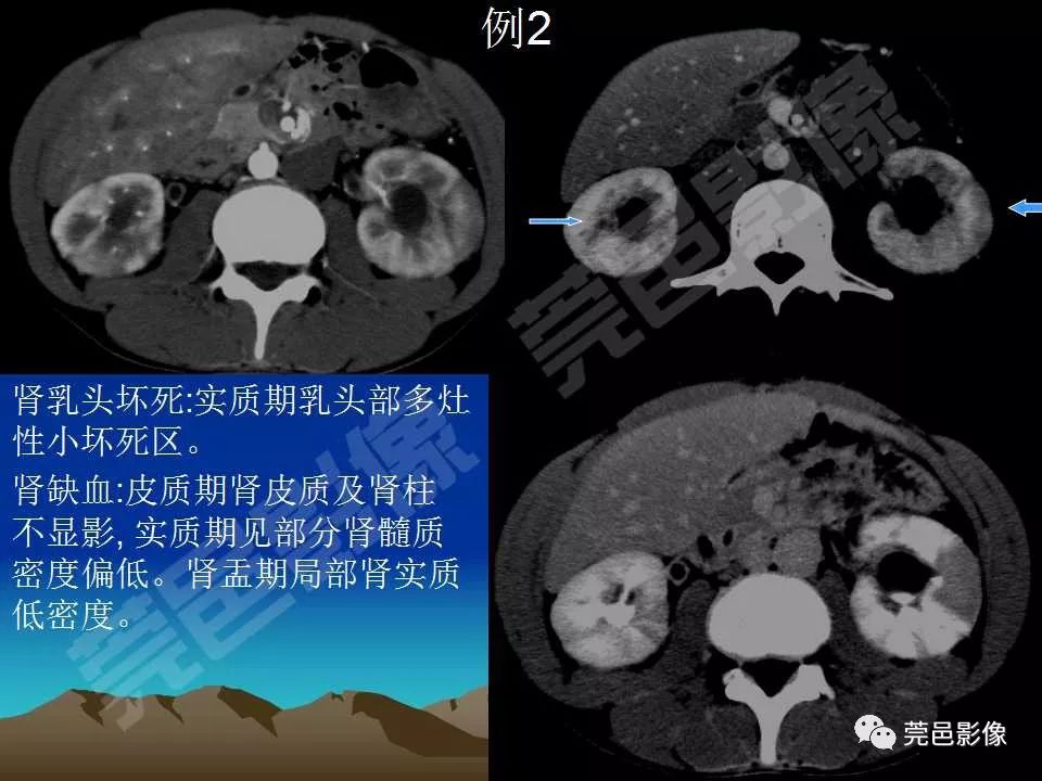 【PPT】氯胺酮相关性肝胆、泌尿系统损害的CT诊断