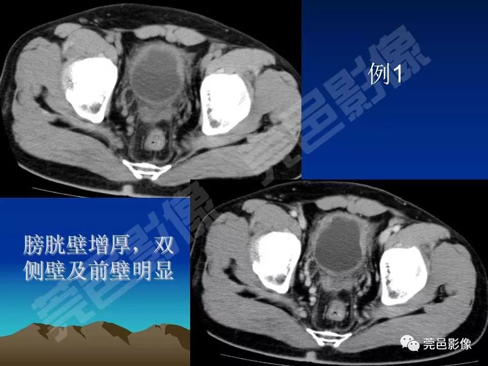 【PPT】氯胺酮相关性肝胆、泌尿系统损害的CT诊断
