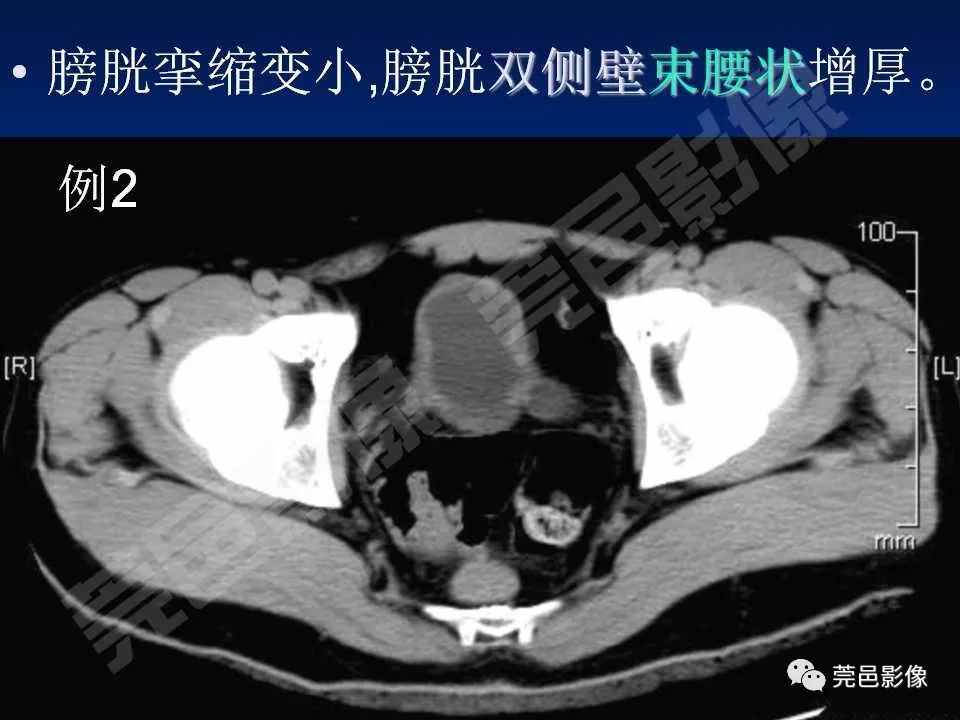 【PPT】氯胺酮相关性肝胆、泌尿系统损害的CT诊断