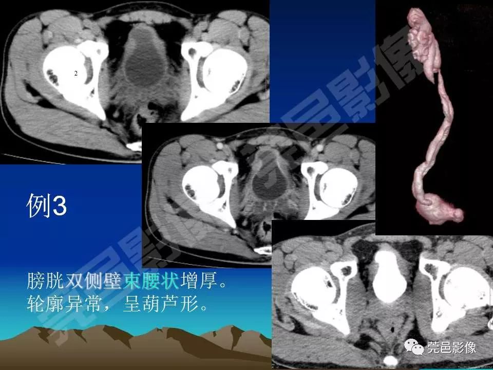 【PPT】氯胺酮相关性肝胆、泌尿系统损害的CT诊断