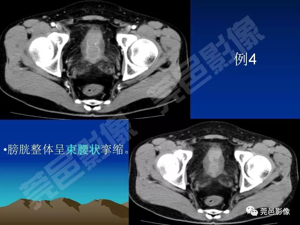 【PPT】氯胺酮相关性肝胆、泌尿系统损害的CT诊断
