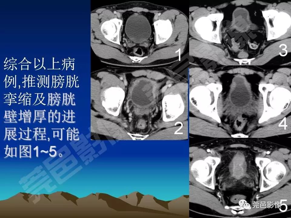 【PPT】氯胺酮相关性肝胆、泌尿系统损害的CT诊断