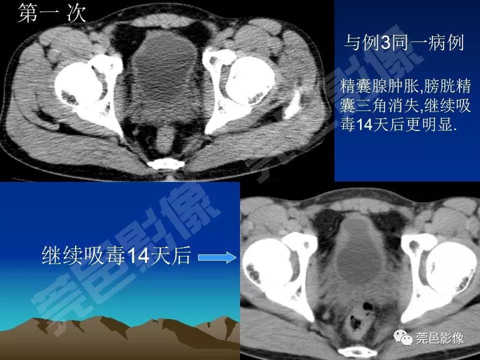 【PPT】氯胺酮相关性肝胆、泌尿系统损害的CT诊断