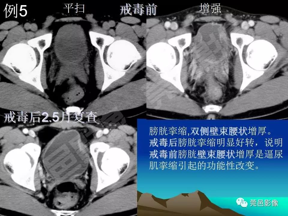 【PPT】氯胺酮相关性肝胆、泌尿系统损害的CT诊断