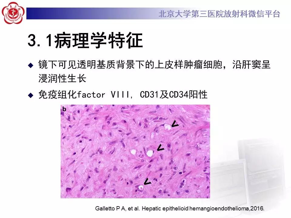 【PPT】肝血管源性肿瘤