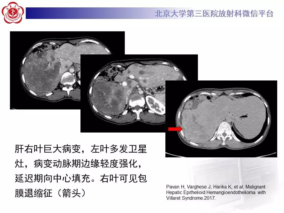 【PPT】肝血管源性肿瘤