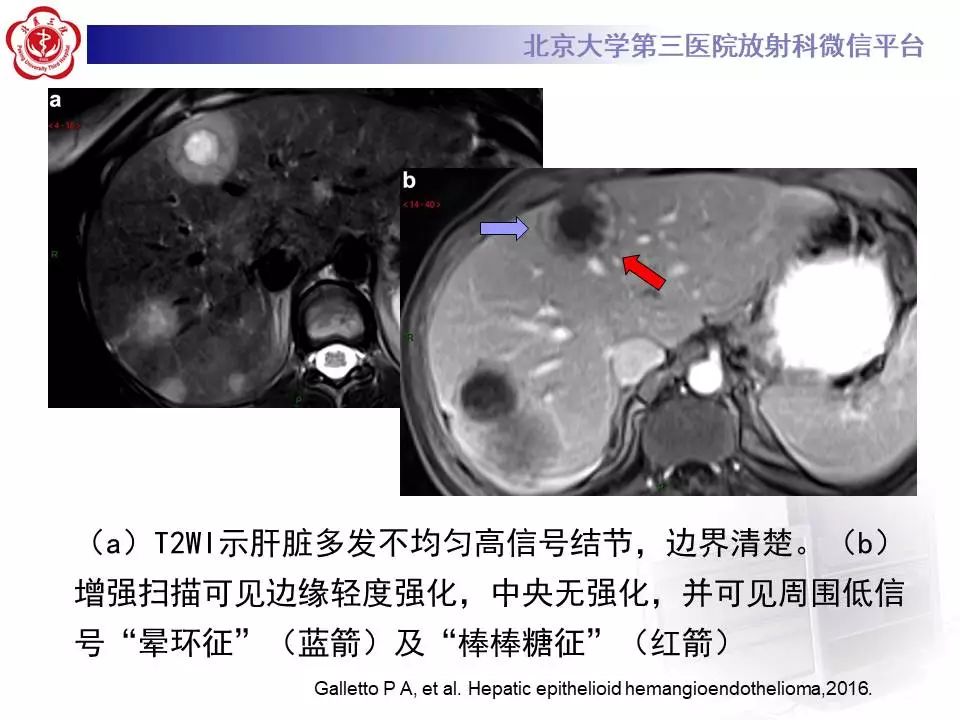 【PPT】肝血管源性肿瘤