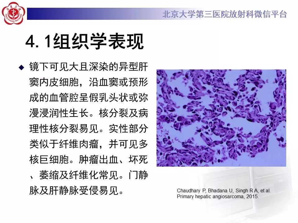 【PPT】肝血管源性肿瘤