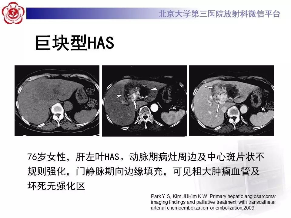 【PPT】肝血管源性肿瘤