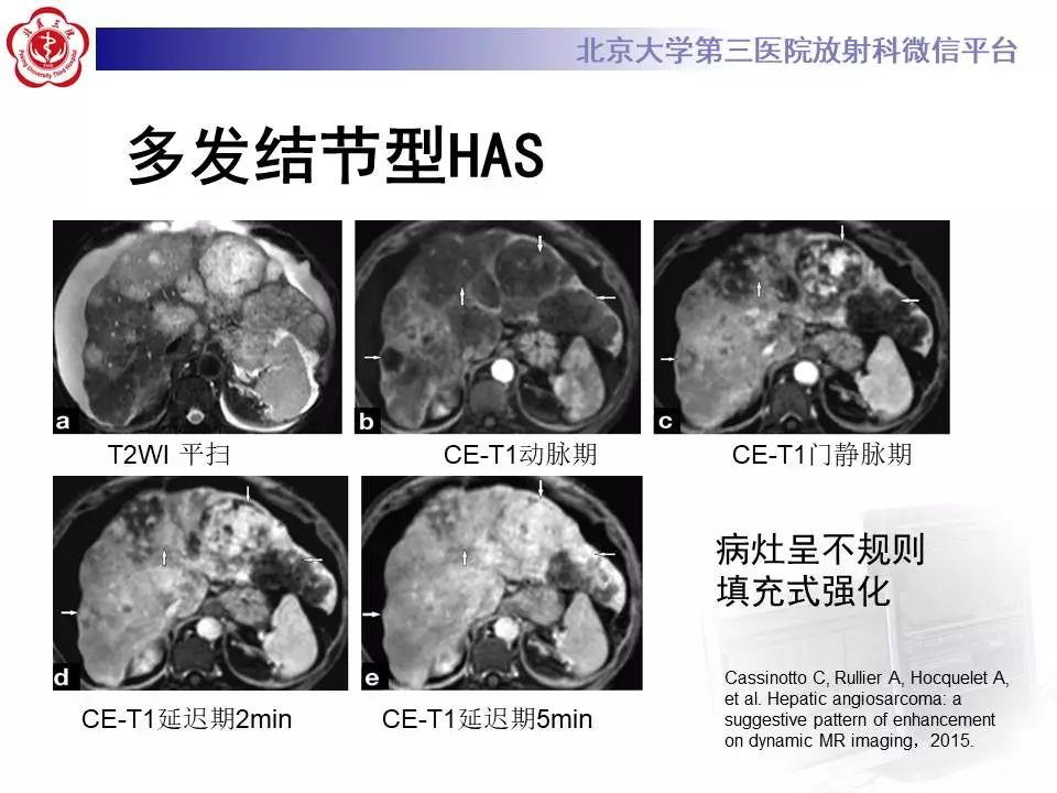 【PPT】肝血管源性肿瘤