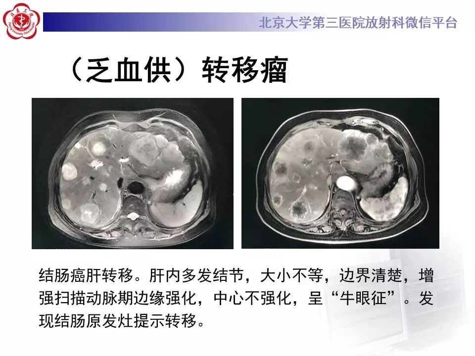 【PPT】肝血管源性肿瘤