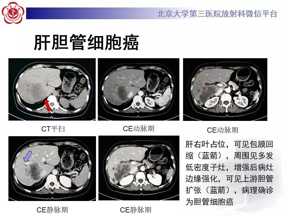 【PPT】肝血管源性肿瘤