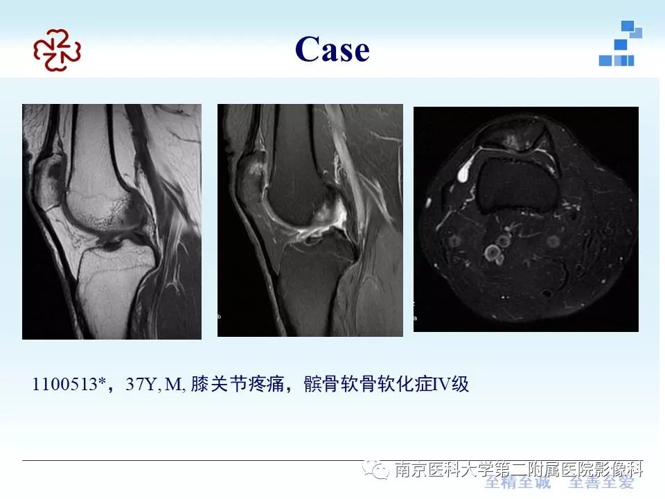【PPT】髌骨软骨软化症