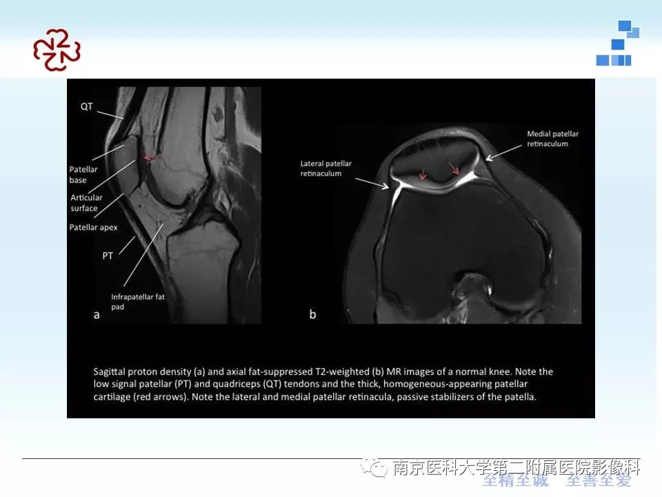 【PPT】髌骨软骨软化症