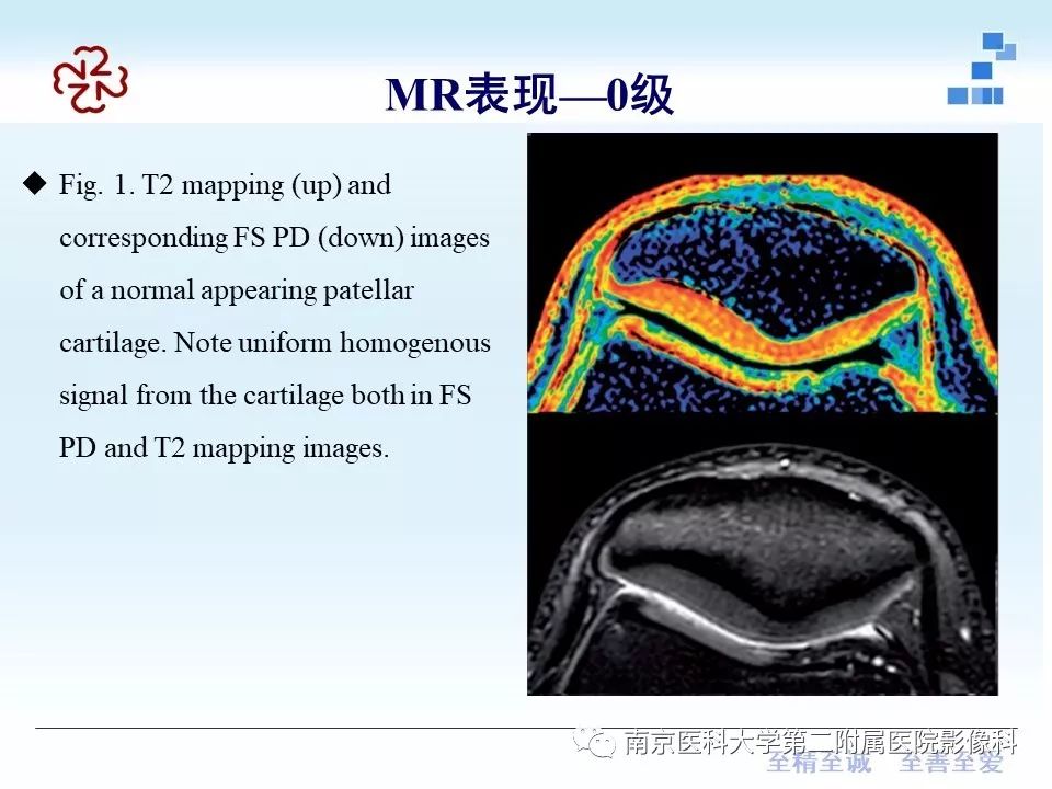 【PPT】髌骨软骨软化症