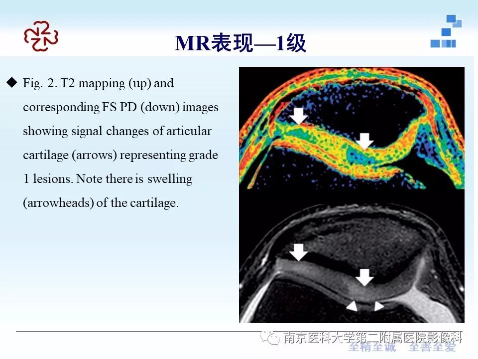 【PPT】髌骨软骨软化症