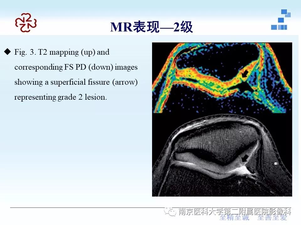 【PPT】髌骨软骨软化症