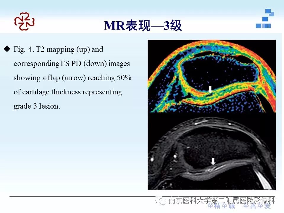 【PPT】髌骨软骨软化症