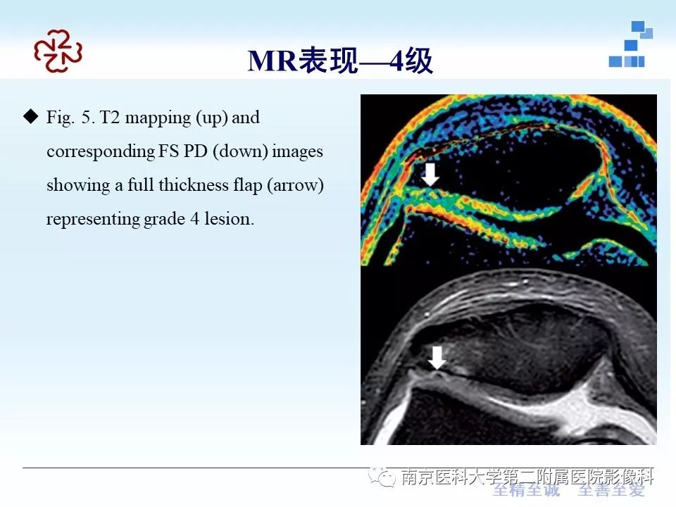 【PPT】髌骨软骨软化症