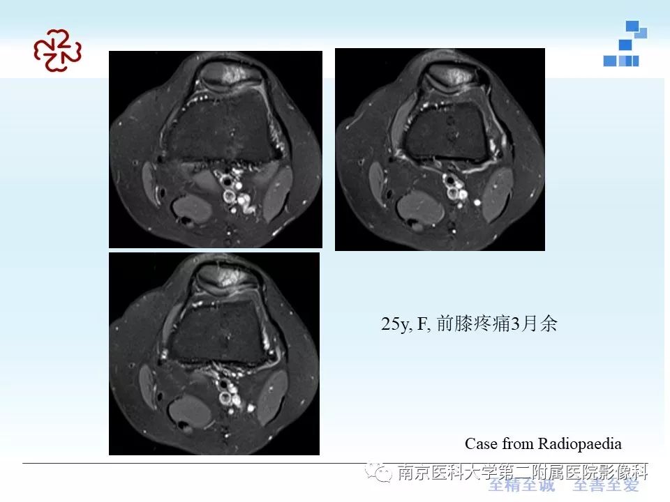 【PPT】髌骨软骨软化症