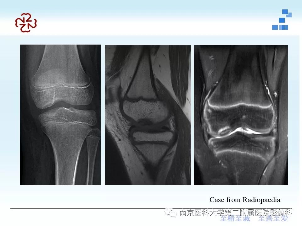 【PPT】髌骨软骨软化症