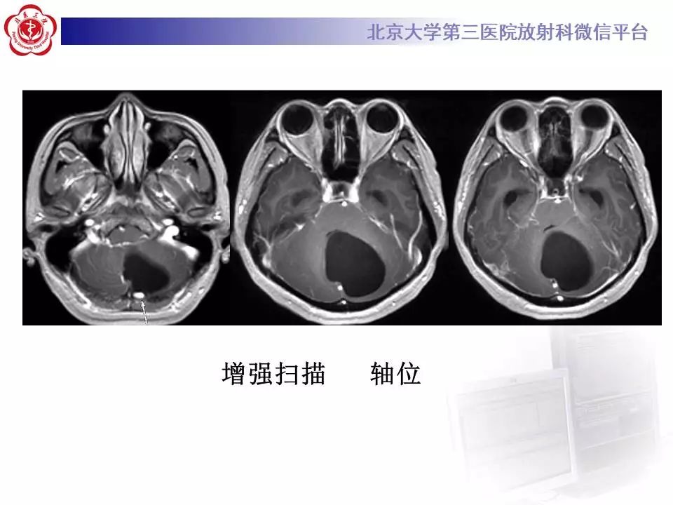 【病例】小脑血管母细胞瘤1例MR影像表现