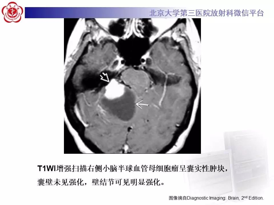 【病例】小脑血管母细胞瘤1例MR影像表现