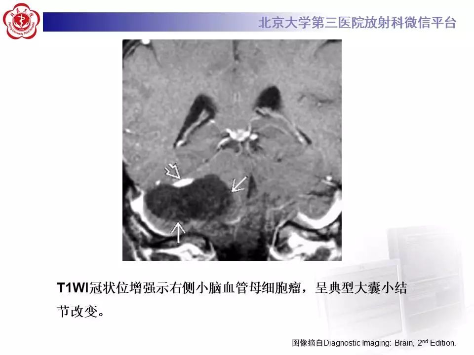 【病例】小脑血管母细胞瘤1例MR影像表现
