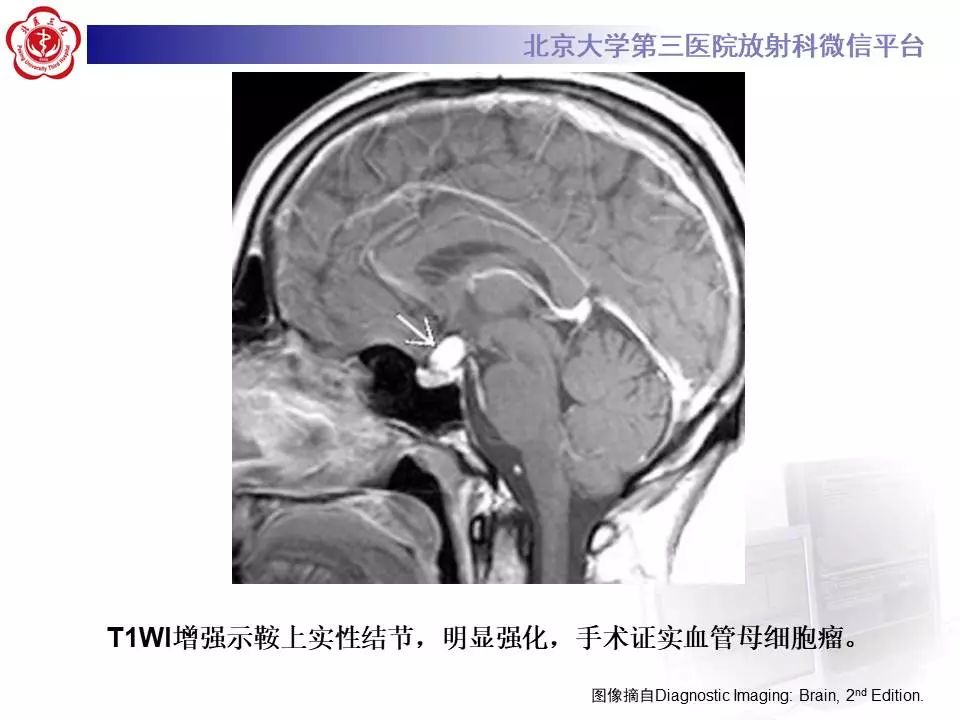 【病例】小脑血管母细胞瘤1例MR影像表现