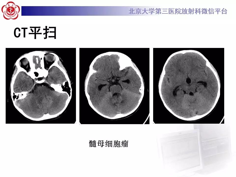 【病例】小脑血管母细胞瘤1例MR影像表现