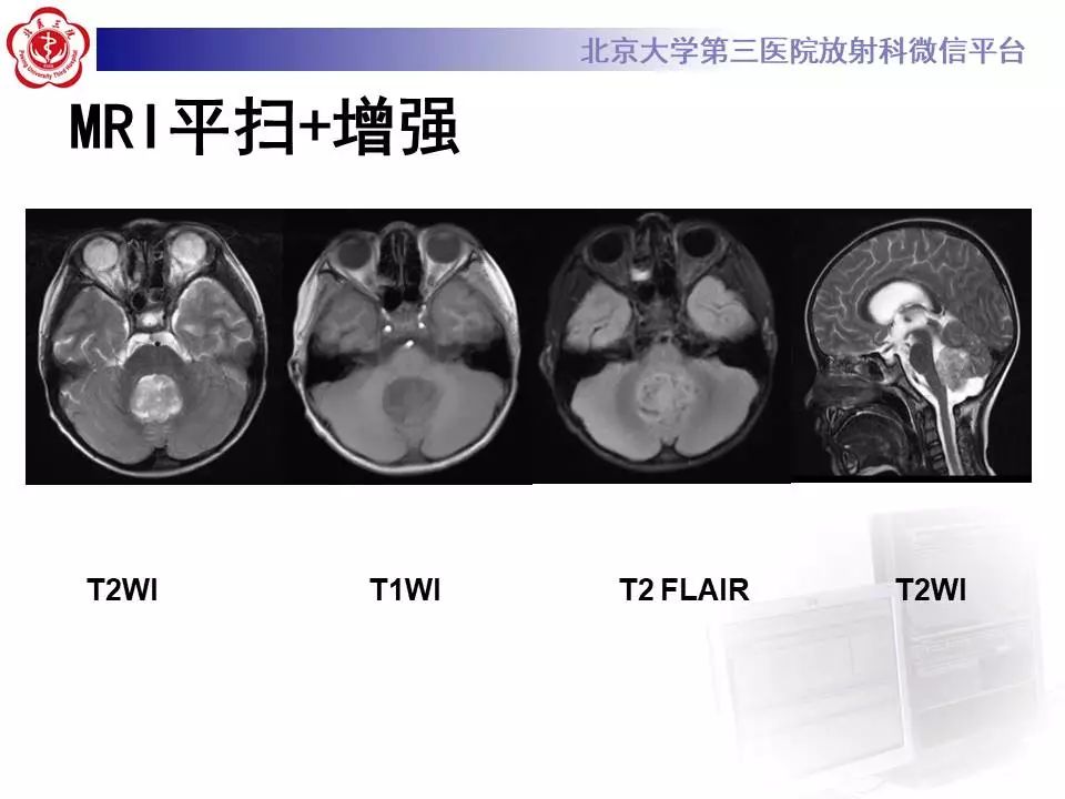【病例】小脑血管母细胞瘤1例MR影像表现