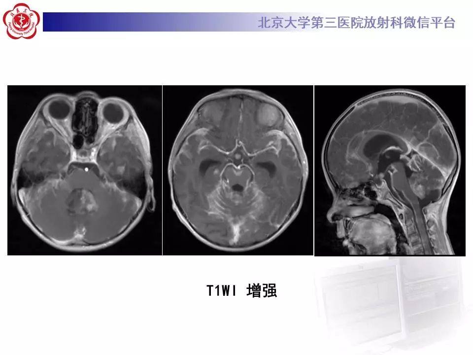 【病例】小脑血管母细胞瘤1例MR影像表现
