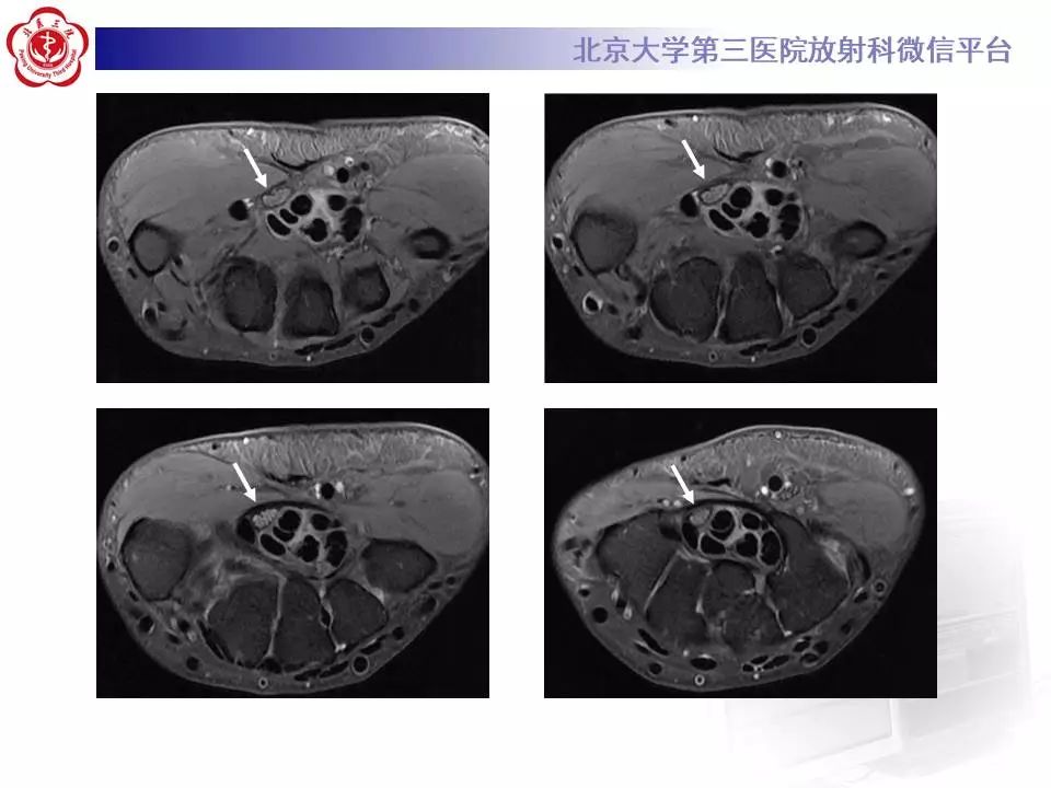 【病例】腕管综合征1例MR影像表现