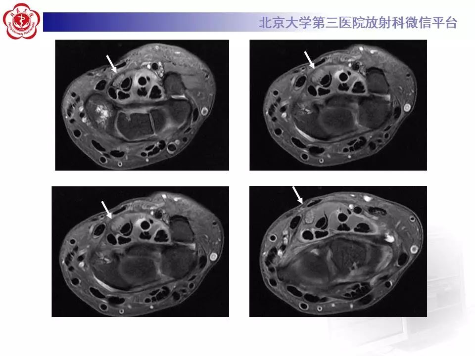 【病例】腕管综合征1例MR影像表现
